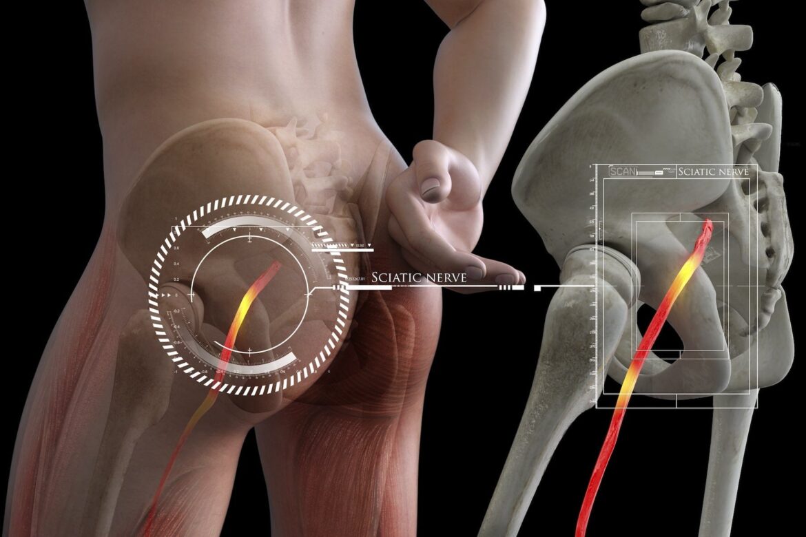 Sciatica nerve 1c511d95 b3ef 4936 ab29 9a2d7611ca71