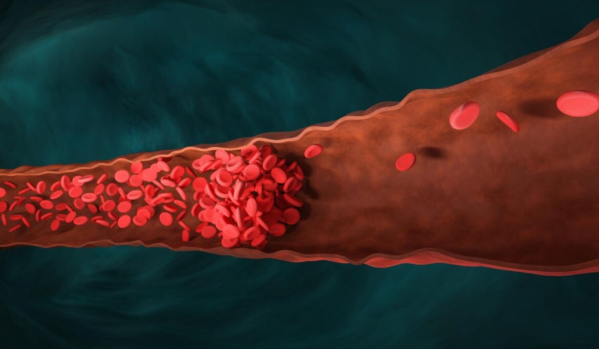 Deep vein thrombosis 319767ee c9f9 45a9 bdae 310a8dd3bdae