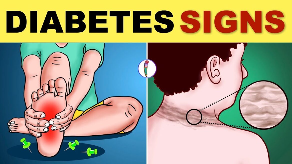 Diabetes Symptoms | Diabetes Mellitus | Type 2 Diabetes 