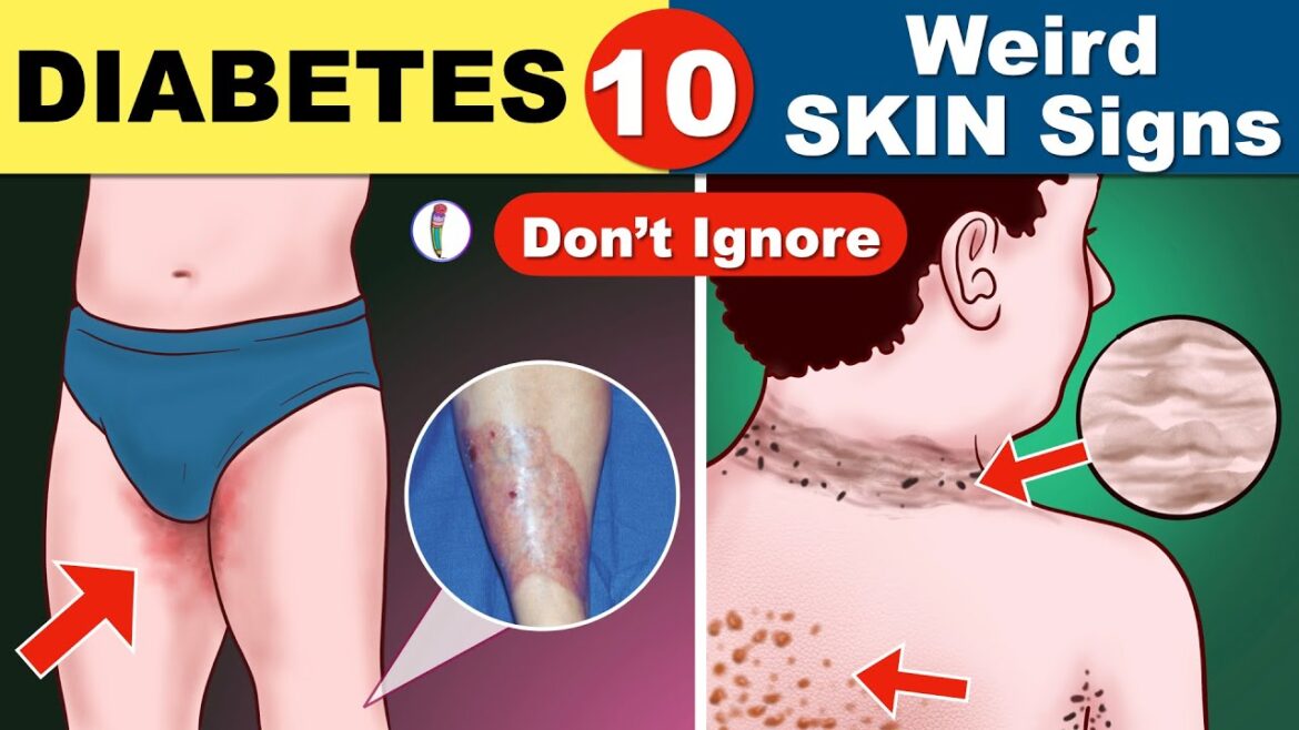 Diabetes Skin Signs | Diabetes Symptoms | Signs Of Diabetes