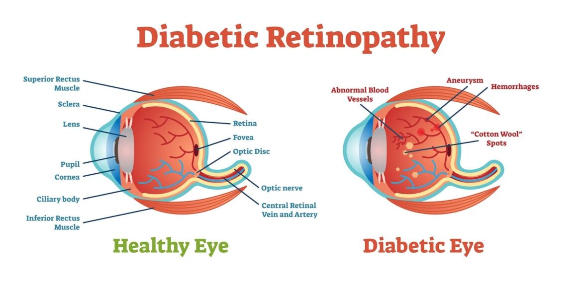 Diabetic retinopathy 195651d5 510c 4863 8a35 c294cded5698
