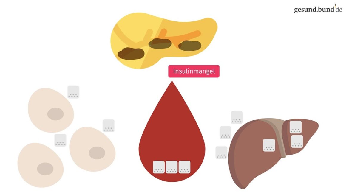 Was Ist Typ 1 Diabetes?
