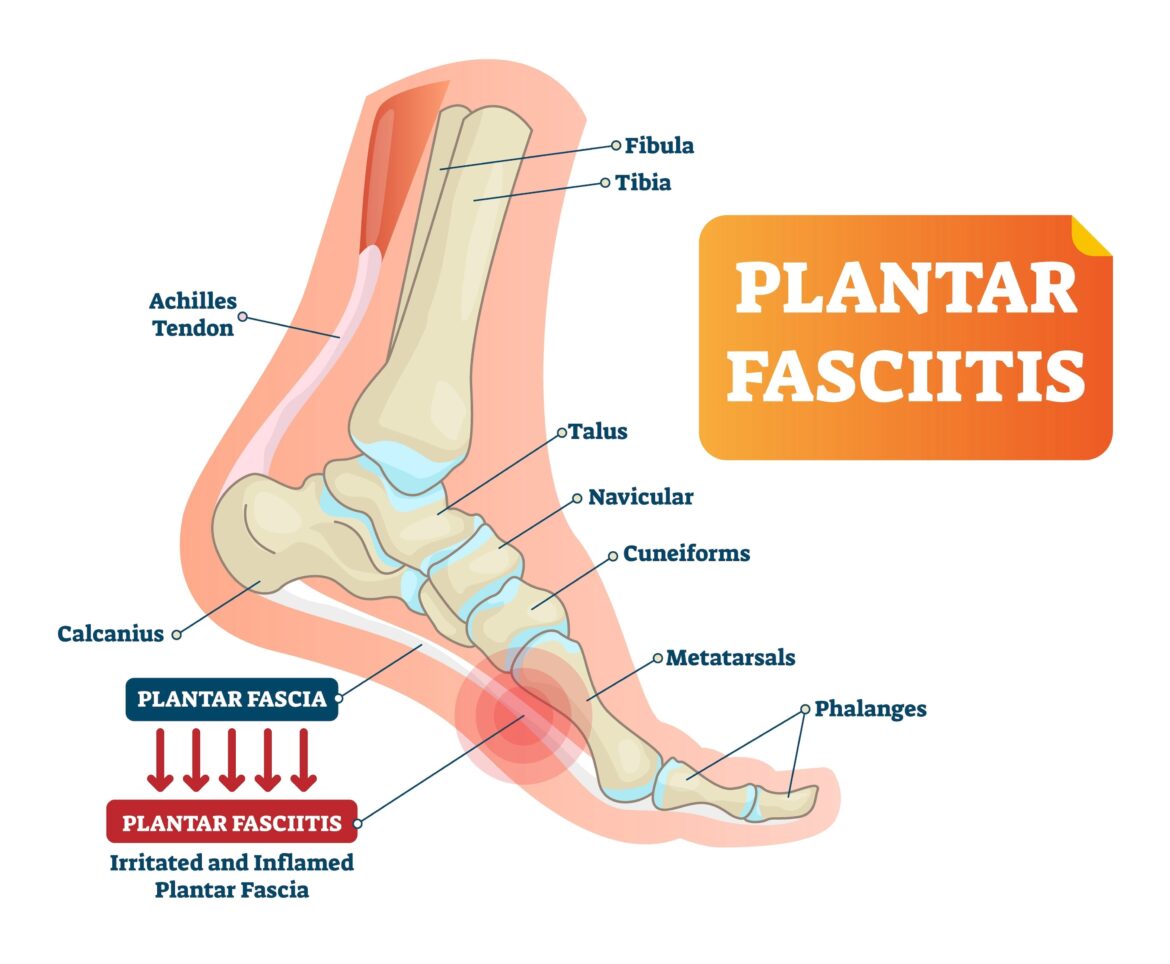 Plantar fasciitis 822a892a f5e5 4b09 9c22 aee13892c5d0