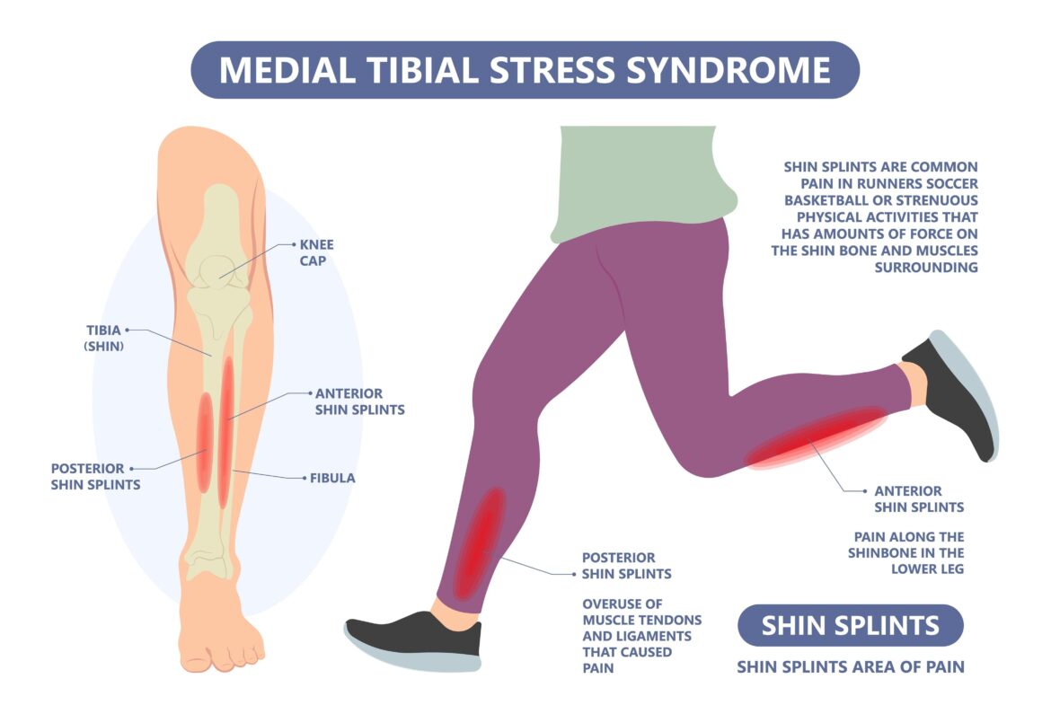 Shin splints 9576b397 106a 4280 bbc4 b28774387c51