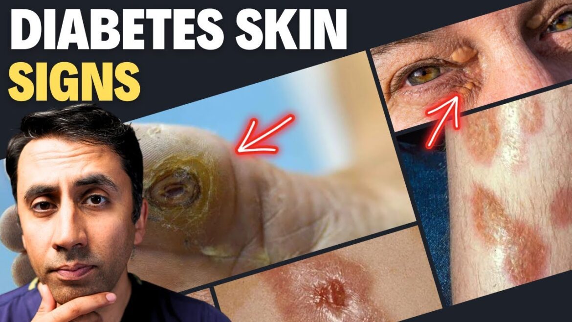 Doctor Explains 13 Skin Signs Of Diabetes Never Ignore