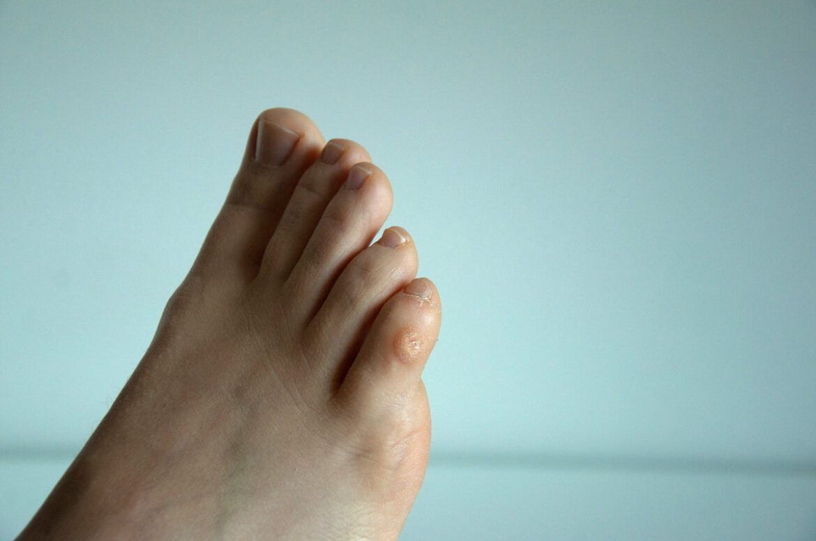Corns on feet 20a9abae c4d4 41bb a6cf a87c9b3d34db 1200x1200