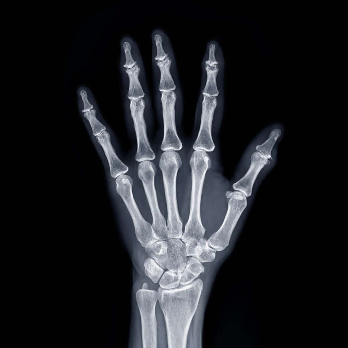 65: diabetes related musculoskeletal issues (trigger finger, frozen shoulder, arthritis and other musculoskeletal issues)