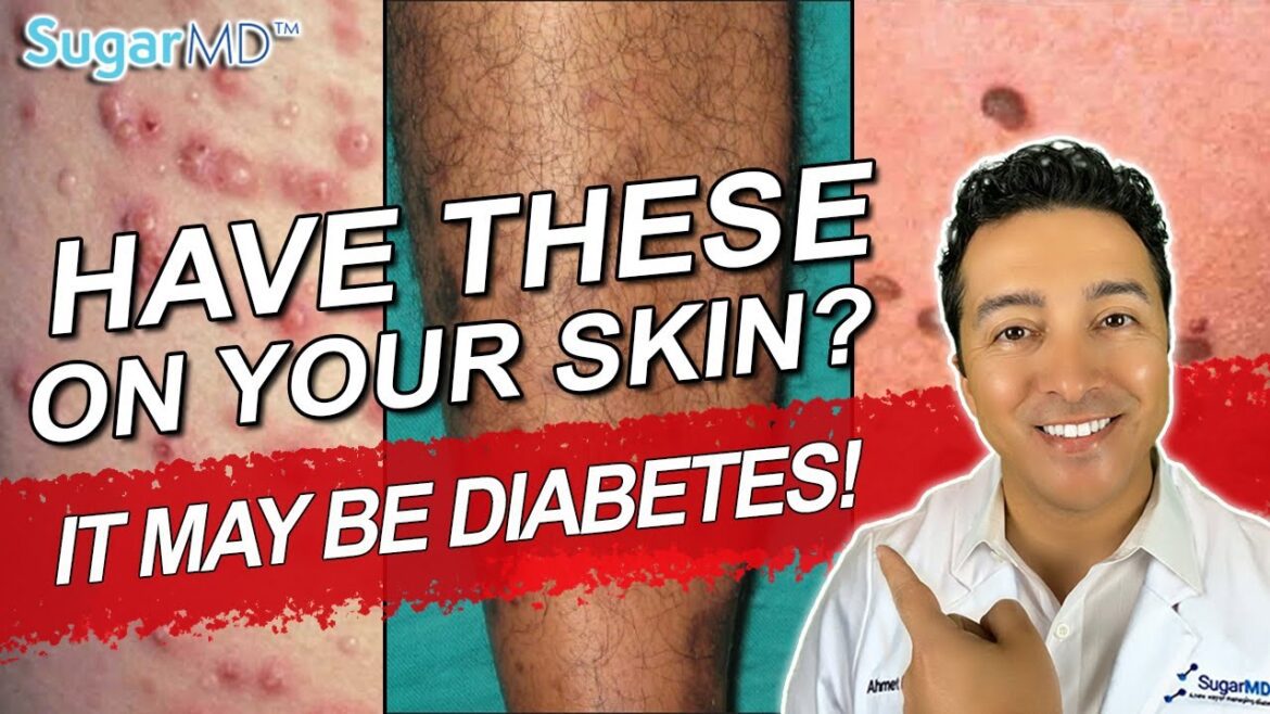 12 Diabetic Skin Problems & Top Signs of Diabetes on