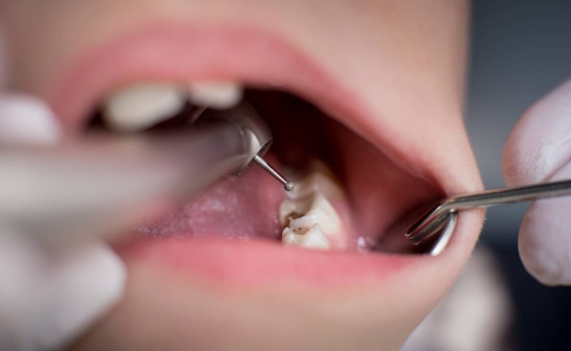 Open mouth during drilling treatment at the dentist in dental clinic. Close up. Dentistry
