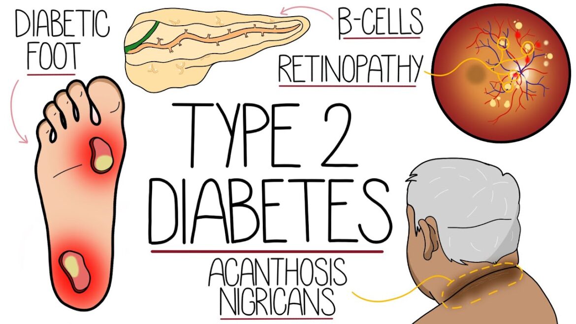 Type 2 Diabetes Mellitus Explained (Including Complications and Treatment)